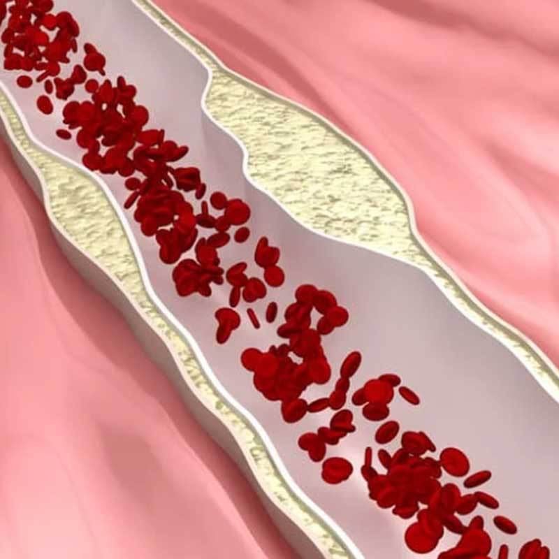 Schematische Darstellung eines Blutgefäßes mit beginnender Arterienverkalkung – Ablagerungen (Plaques) verengen die Gefäßwand, rote Blutkörperchen fließen durch die Mitte.
